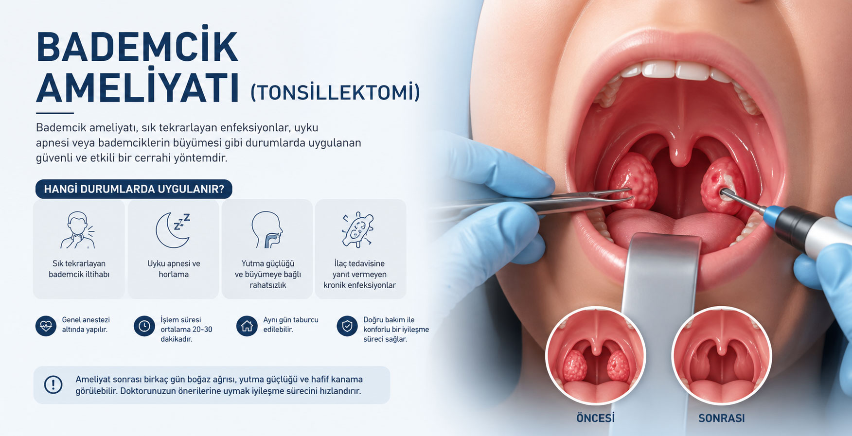 Bademcik Ameliyatı (Tonsillektomi)